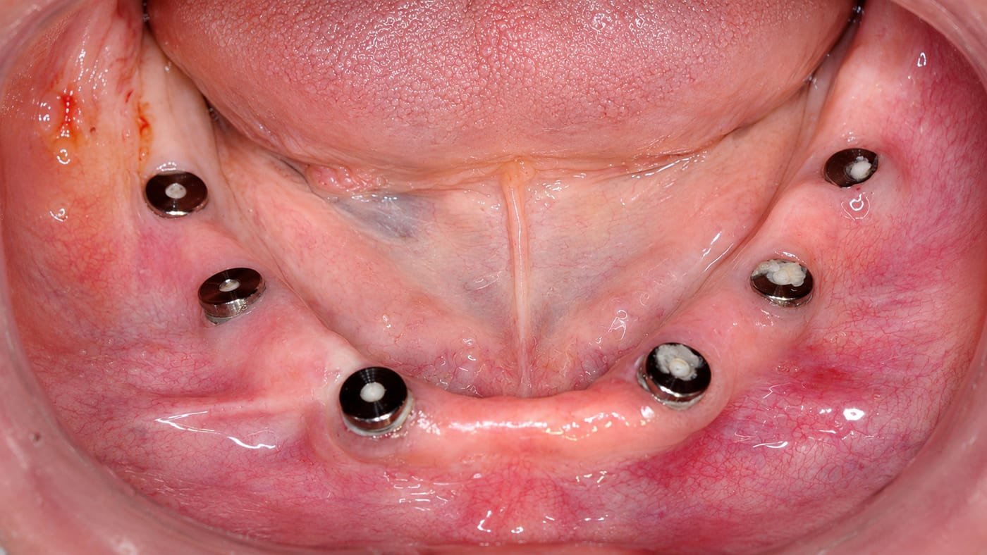 Implantes dentales colocados