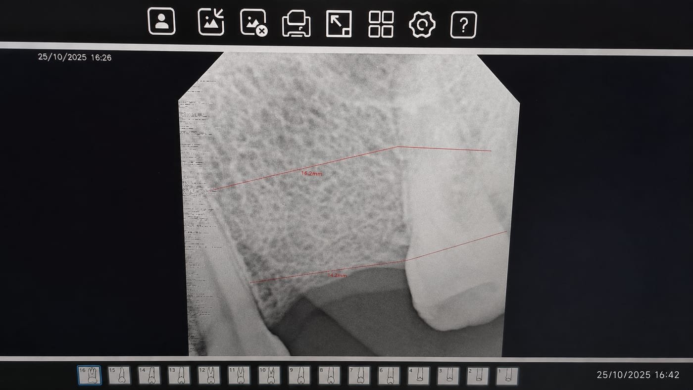 Planificación con radiografía